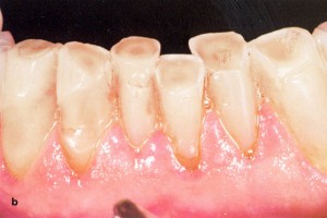 Stipriai išreikštas apatinio žandikaulio priekinių dantų nudilimas